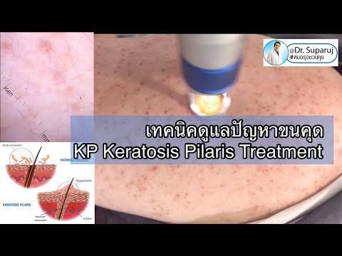 เทคนิคดูแลปัญหาขนคุด KP Keratosis Pilaris Treatment หมอรุจชวนคุย รักษาขนคุด เลเซอร์ขนคุด