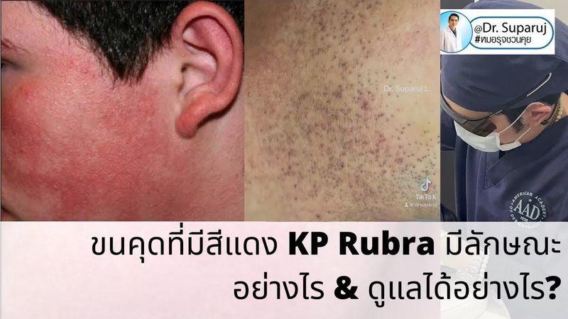 ขนคุดที่มีสีแดง KP Rubra มีลักษณะอย่างไร & ดูแลได้อย่างไร?